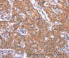 Immunohistochemistry of paraffin-embedded Human gastic cancer using CD269 Polyclonal Antibody at dilution of 1:30