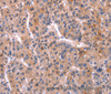 Immunohistochemistry of paraffin-embedded Human liver cancer using CD269 Polyclonal Antibody at dilution of 1:30