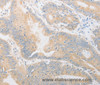 Immunohistochemistry of paraffin-embedded Human colon cancer using CD24 Polyclonal Antibody at dilution of 1:40
