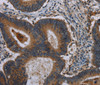 Immunohistochemistry of paraffin-embedded Human colon cancer using MAP3K11 Polyclonal Antibody at dilution of 1:40