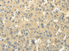 Immunohistochemistry of paraffin-embedded Human liver cancer using PMP2 Polyclonal Antibody at dilution of  1/25