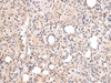Immunohistochemistry of paraffin-embedded Human thyroid cancer using CBX7 Polyclonal Antibody at dilution of  1/20