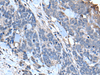 Immunohistochemistry of paraffin-embedded Human thyroid cancer tissue  using TPT1 Polyclonal Antibody at dilution of 1:85(×200)