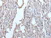 Immunohistochemistry of paraffin-embedded Human colorectal cancer tissue  using TPT1 Polyclonal Antibody at dilution of 1:85(×200)