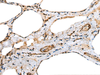 Immunohistochemistry of paraffin-embedded Human thyroid cancer tissue  using TNNC1 Polyclonal Antibody at dilution of 1:25(×200)