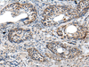 Immunohistochemistry of paraffin-embedded Human cervical cancer tissue  using PRNP Polyclonal Antibody at dilution of 1:45(×200)