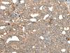 Immunohistochemistry of paraffin-embedded Human liver cancer tissue  using BRD9 Polyclonal Antibody at dilution of 1:80(×200)