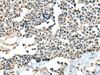 Immunohistochemistry of paraffin-embedded Human lung cancer tissue  using CALHM1 Polyclonal Antibody at dilution of 1:60(×200)