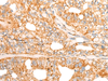 Immunohistochemistry of paraffin-embedded Human gastric cancer tissue  using CHCHD3 Polyclonal Antibody at dilution of 1:45(×200)