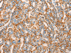 Immunohistochemistry of paraffin-embedded Human liver cancer tissue  using CHCHD3 Polyclonal Antibody at dilution of 1:45(×200)
