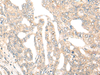 Immunohistochemistry of paraffin-embedded Human liver cancer tissue  using DCP2 Polyclonal Antibody at dilution of 1:45(×200)