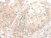 Immunohistochemistry of paraffin-embedded Human gastric cancer tissue  using DCP2 Polyclonal Antibody at dilution of 1:45(×200)