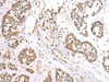 Immunohistochemistry of paraffin-embedded Human esophagus cancer tissue  using BAG2 Polyclonal Antibody at dilution of 1:40(×200)