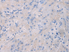 Immunohistochemistry of paraffin-embedded Human gastric cancer tissue  using NFKB1 Polyclonal Antibody at dilution of 1:80(×200)