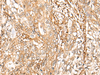 Immunohistochemistry of paraffin-embedded Human gastric cancer tissue  using CD99 Polyclonal Antibody at dilution of 1:40(×200)