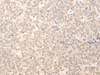 Immunohistochemistry of paraffin-embedded Human ovarian cancer tissue  using RUVBL2 Polyclonal Antibody at dilution of 1:25(×200)