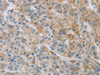 Immunohistochemistry of paraffin-embedded Human liver cancer tissue  using ZAK  Polyclonal Antibody at dilution of 1:100(×200)