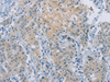 Immunohistochemistry of paraffin-embedded Human gastric cancer tissue  using ZAK  Polyclonal Antibody at dilution of 1:100(×200)