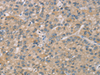 Immunohistochemistry of paraffin-embedded Human liver cancer tissue  using ZBTB3  Polyclonal Antibody at dilution of 1:50(×200)