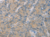Immunohistochemistry of paraffin-embedded Human liver cancer tissue  using ZBTB6  Polyclonal Antibody at dilution of 1:50(×200)