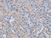 Immunohistochemistry of paraffin-embedded Human liver cancer tissue  using CREBZF Polyclonal Antibody at dilution of 1:50(×200)