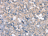 Immunohistochemistry of paraffin-embedded Human thyroid cancer tissue  using ZFYVE16  Polyclonal Antibody at dilution of 1:60(×200)