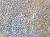 Immunohistochemistry of paraffin-embedded Human cervical cancer tissue  using ZHX3  Polyclonal Antibody at dilution of 1:100(×200)