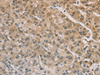 Immunohistochemistry of paraffin-embedded Human liver cancer tissue  using ZIC2  Polyclonal Antibody at dilution of 1:100(×200)