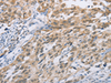 Immunohistochemistry of paraffin-embedded Human esophagus cancer tissue  using ZIC5  Polyclonal Antibody at dilution of 1:100(×200)