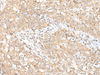 Immunohistochemistry of paraffin-embedded Human esophagus cancer tissue  using CHRNB2 Polyclonal Antibody at dilution of 1:50(×200)
