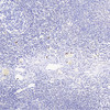 Immunohistochemistry analysis of paraffin-embedded Human amygdalitis  using ITGAX Polyclonal Antibody at dilution of 1:200.
