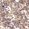 Immunohistochemistry analysis of paraffin-embedded human lung cancer   using JUN Polyclonal Antibody at dilution of 1:500.
