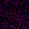 Immunofluorescence analysis of paraffin-embedded human liver cancer  using GSK3 beta Polyclonal Antibody at dilution of 1:300.