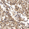 Immunohistochemistry analysis of paraffin-embedded human lung cancer  using p27 Polyclonal Antibody at dilution of 1:200.