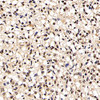 Immunohistochemistry analysis of paraffin-embedded human liver cancer  using p27 Polyclonal Antibody at dilution of 1:200.