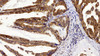 Immunohistochemistry analysis of paraffin-embedded human stomach cancer  using CHOP Polyclonal Antibody at dilution of 1:300.