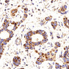 Immunohistochemistry analysis of paraffin-embedded human liver cancer  using COX4I1 Polyclonal Antibody at dilution of 1:200.