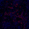 Immunofluorescence analysis of paraffin-embedded Human lung cancer  using Cyclin B1 Polyclonal Antibody at dilution of 1:100.