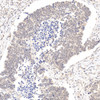 Immunohistochemistry analysis of paraffin-embedded human lung cancer   using ATF6 Polyclonal Antibody at dilution of 1:400.