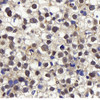 Immunohistochemistry analysis of paraffin-embedded human orchidoncus  using Cyclin E1 Polyclonal Antibody at dilution of 1:400.