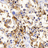 Immunohistochemistry analysis of paraffin-embedded human lung cancer  using AQP1 Polyclonal Antibody at dilution of 1:400.