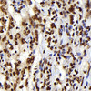 Immunohistochemistry analysis of paraffin-embedded human lymphoma  using S100A4 Monoclonal Antibody at dilution of 1:300.