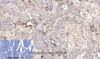 Immunohistochemistry of paraffin-embedded Human lung cancer tissue using CD45 Monoclonal Antibody at dilution of 1:200.