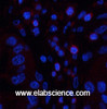 Immunofluorescence analysis of Human liver cancer tissue using CD45 Monoclonal Antibody at dilution of 1:200.