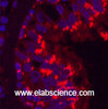 Immunofluorescence analysis of Human lung cancer tissue using CD68 Monoclonal Antibody at dilution of 1:200.