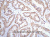 Immunohistochemistry of paraffin-embedded Human colon cancer tissue using p53 Monoclonal Antibody at dilution of 1:200.