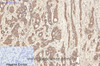 Immunohistochemistry of paraffin-embedded Human liver cancer tissue using AQP4 Monoclonal Antibody at dilution of 1:200.