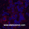 Immunofluorescence analysis of Human liver cancer tissue using FH Monoclonal Antibody at dilution of 1:200.