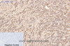 Immunohistochemistry of paraffin-embedded Human breast cancer tissue using AFP Monoclonal Antibody at dilution of 1:200.