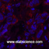 Immunofluorescence analysis of Human breast cancer tissue using AFP Monoclonal Antibody at dilution of 1:200.